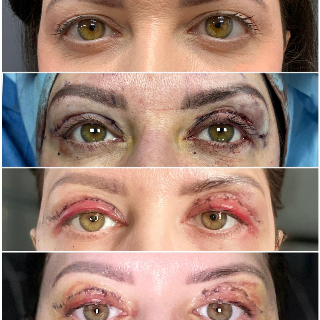 Before, During & After Surgery - Full Transformation Process